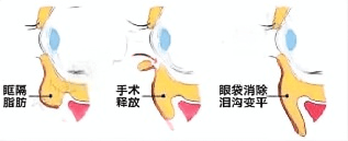眼袋“搬家”，淚溝“消失”！山東省立第三醫院眶隔脂肪釋放術：一場眼周年輕化的“技能升級”